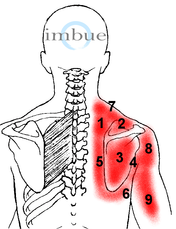 Болит спина левая лопатка причины. Триггерные точки шейно грудной отдел. Триггерные точки шеи и воротниковой зоны. Триггерные точки при сколиозе.
